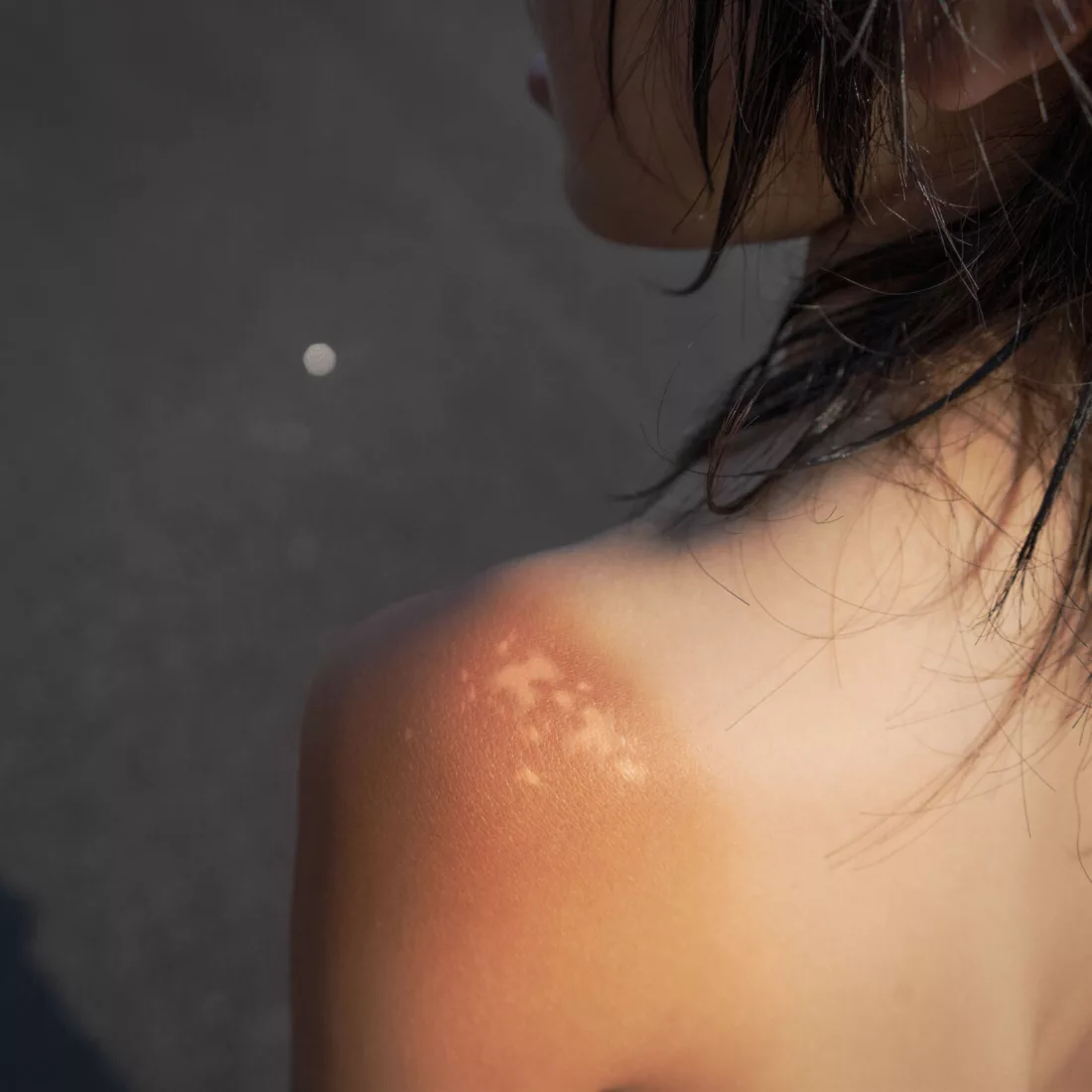 Sunburn takado kido